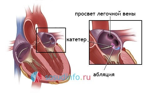 Как поддерживать здоровое питание и образ жизни после радиочастотной абляции сердца?