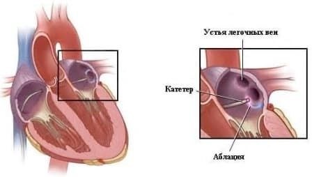 Что следует избегать после радиочастотной абляции сердца?
