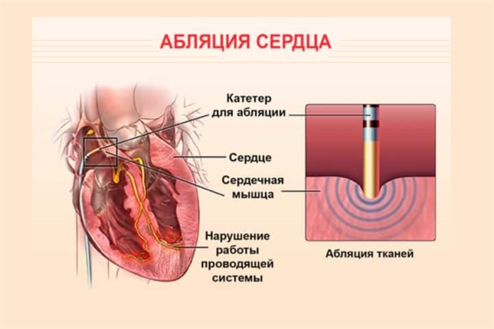 Виды абляции сердца