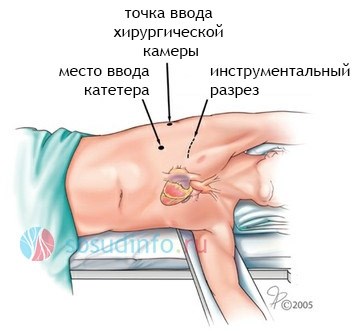 Стоимость операции РЧА