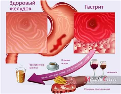 Освобождение от армии по гастриту