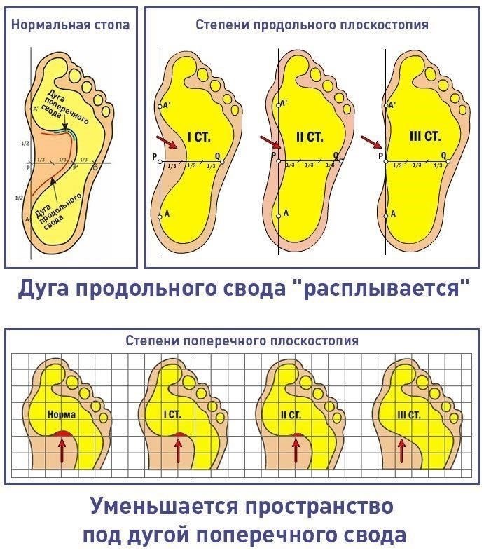 Как подать заявление на освобождение от военной службы из-за плоскостопия